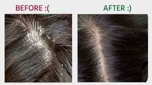 DANDRUFF TREATMENT