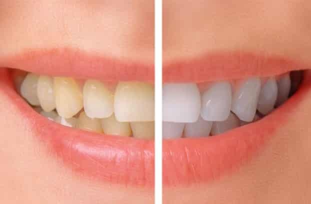 Teeth Whitening