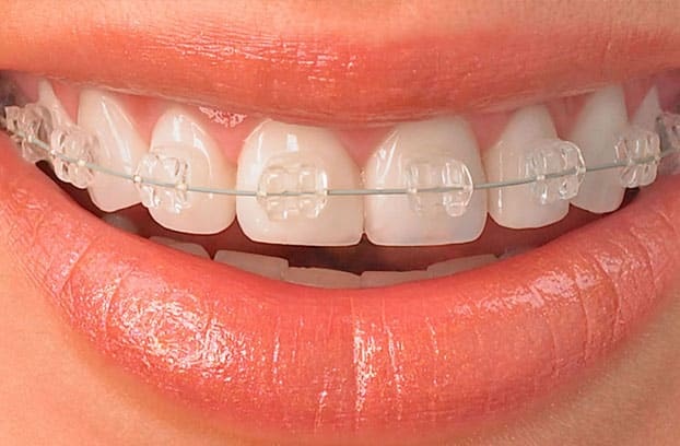 Orthodontics (Braces)