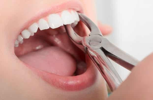 Dental Extraction