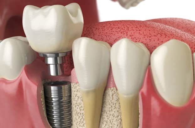 Dental Implants