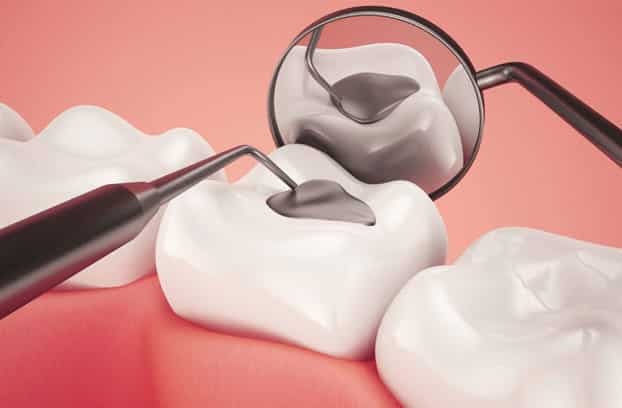 Tooth Fillings