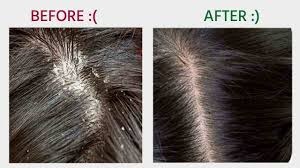 Dandruff & Henna Treatment for Hair