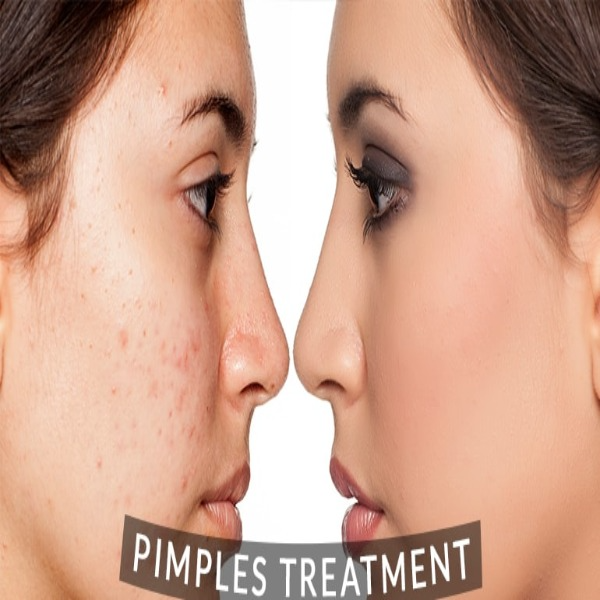 PIMPLE TREATMENT