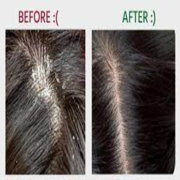 DANDRUFF & HENNA TREATMENT FOR HAIR