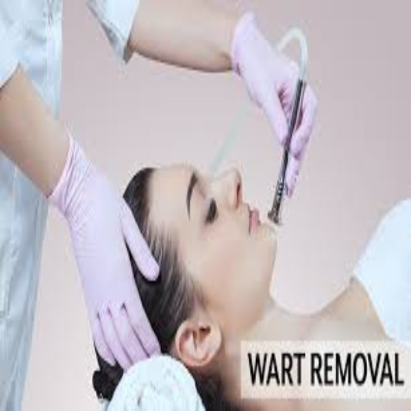 WARTS REMOVING