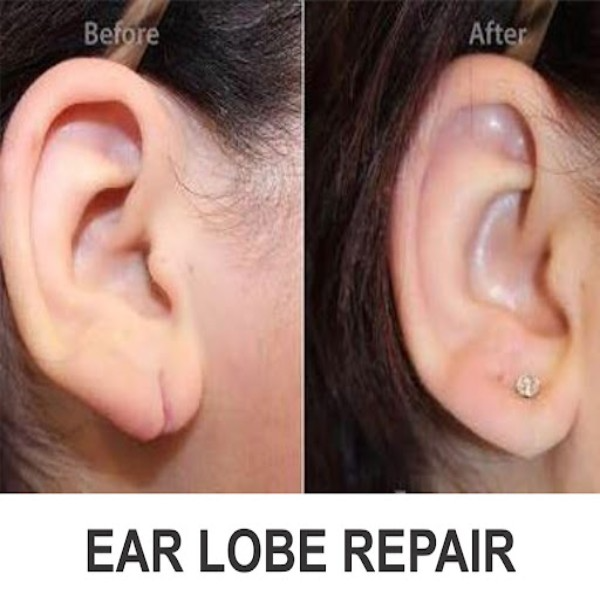 EAR LOBE Repairing