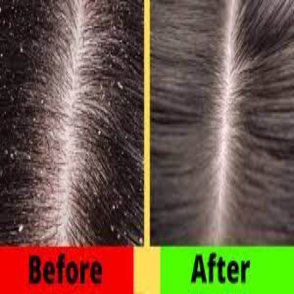 Dandruff Treatment