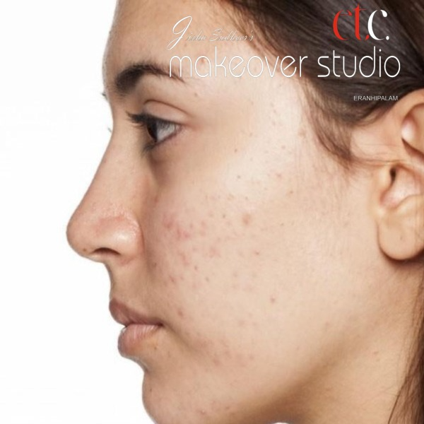 Pimple Treatment