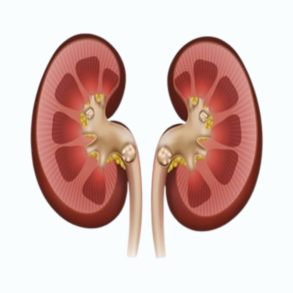Kidney Stone