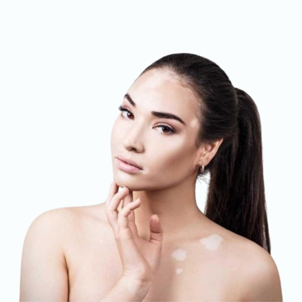 Vitiligo