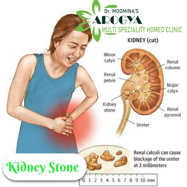 Kidney Stone