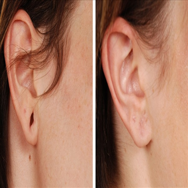 Earlobe Repair