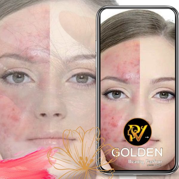 Pimple Treatment