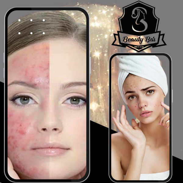 Pimple Treatment