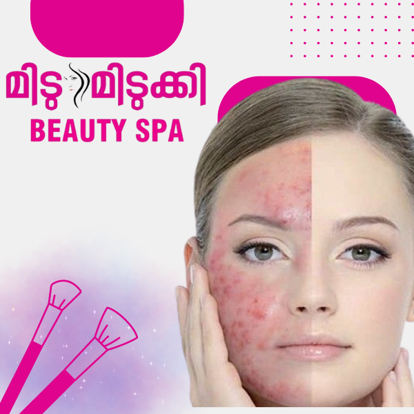 Pimple Treatment