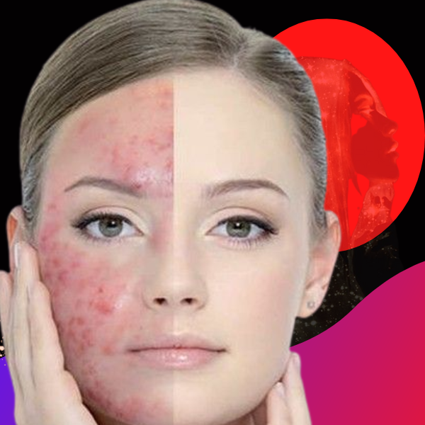 Pimple Treatment