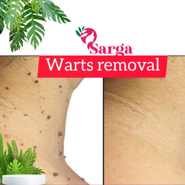 WARTS REMOVING
