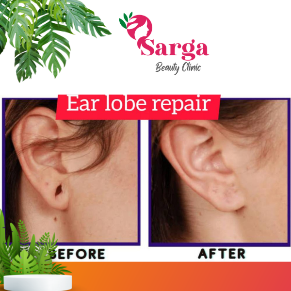 Earlobe Repair