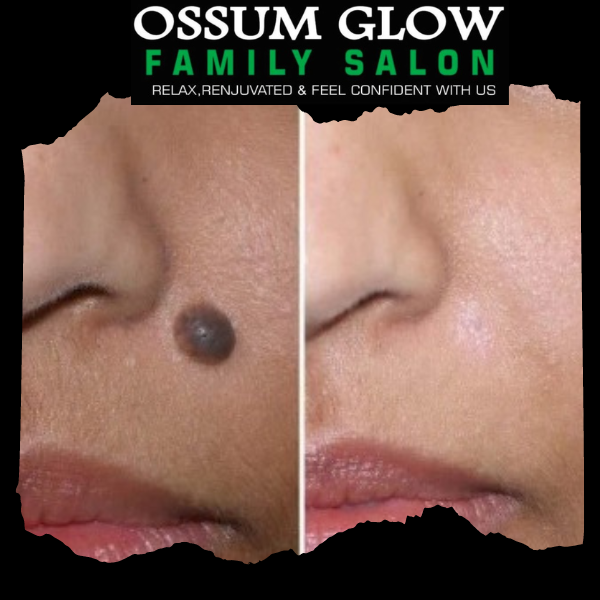 Laser Mole Removal