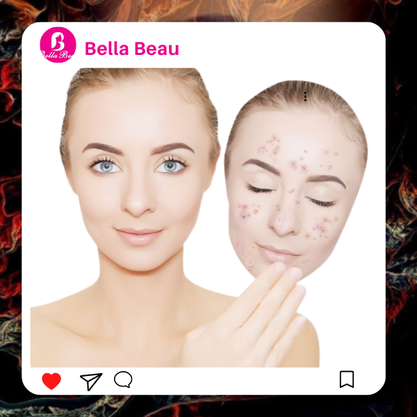 Pimple Treatment