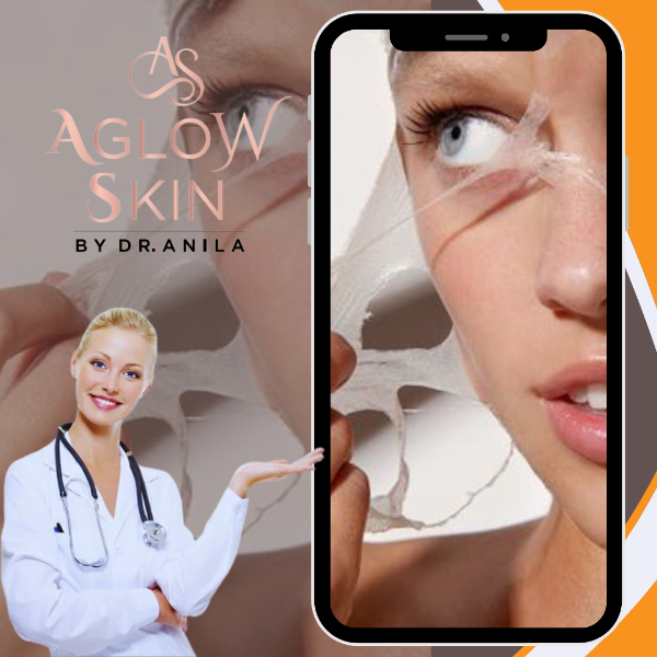 Chemical Peel