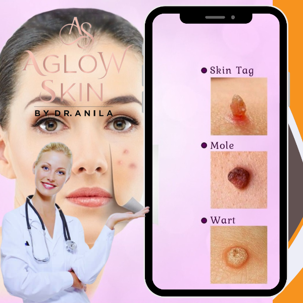 Warts, Mole & Tag Removal