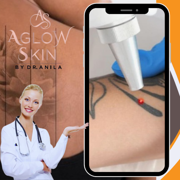 Laser Tatoo Removal