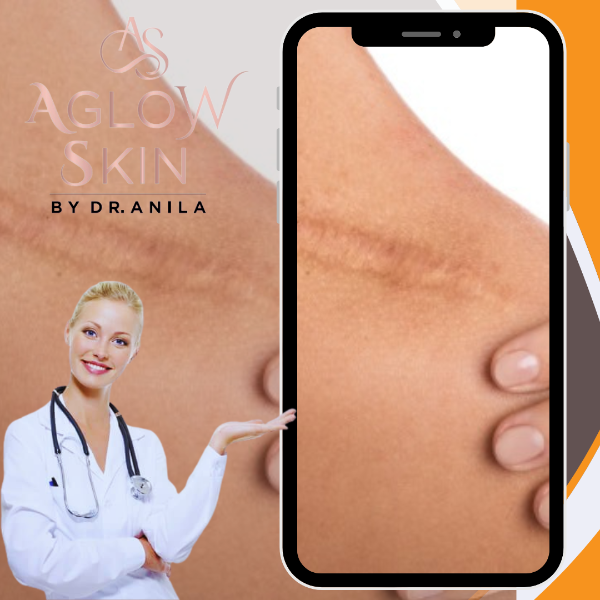 Scar Reduction