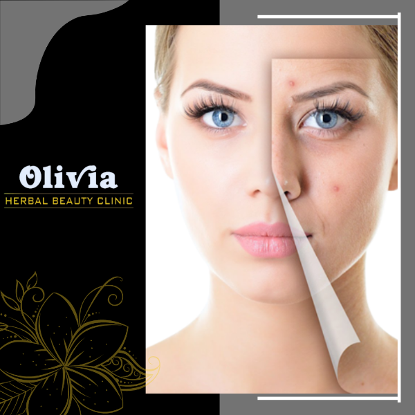 Pimple Treatment