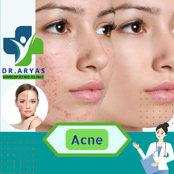 Acne Treatment