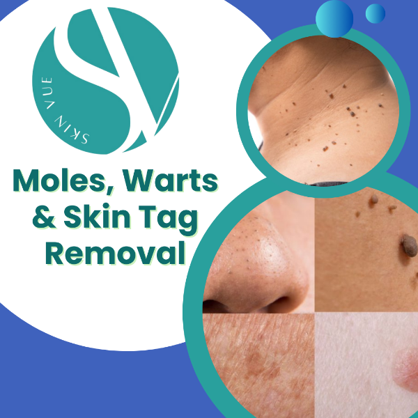 Moles, Warts & Skin Tag Removal