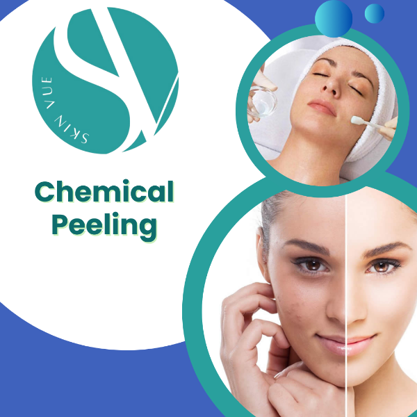 Chemical Peeling