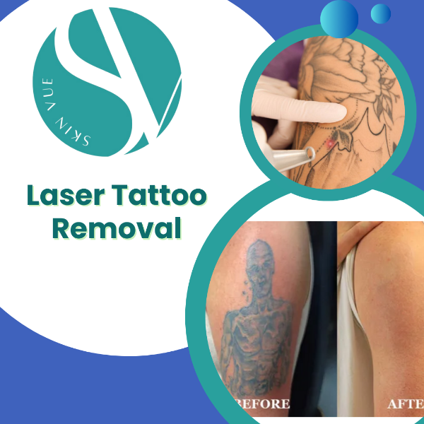 Laser Tattoo Removal