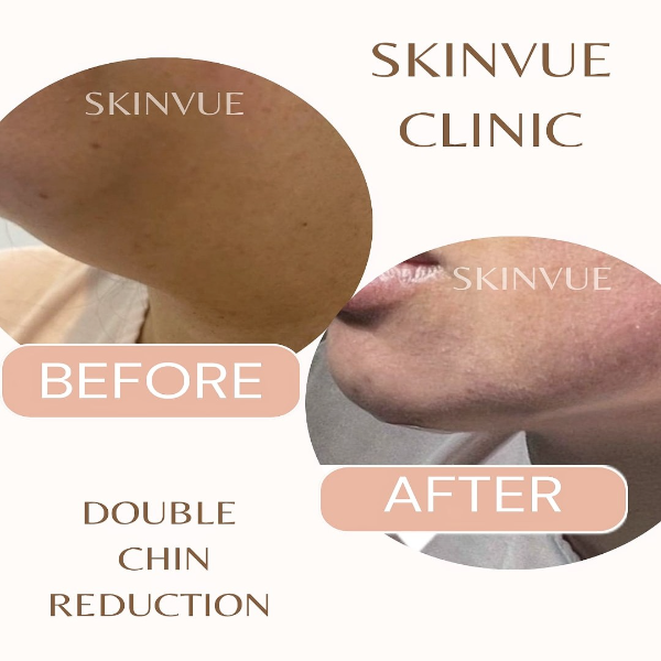 SKINVUE Clinic