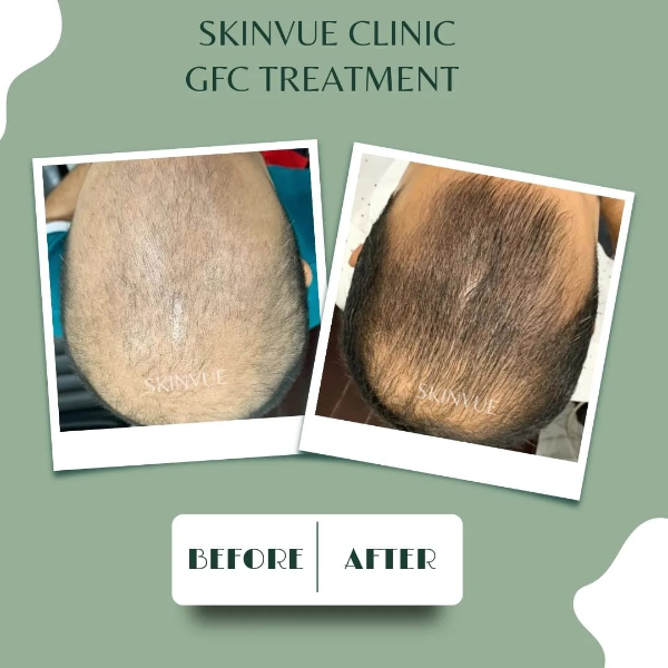 GFC TREATMENT