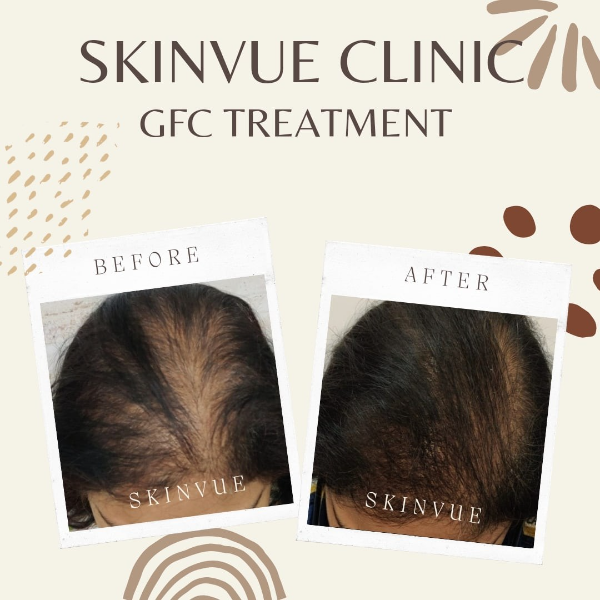 GFC TREATMENT