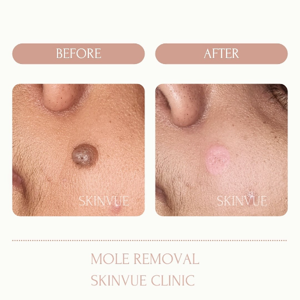 Mole Removal