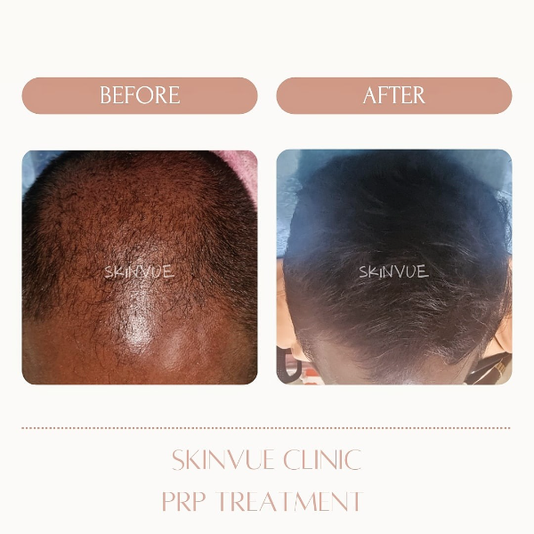 PRP Treatment