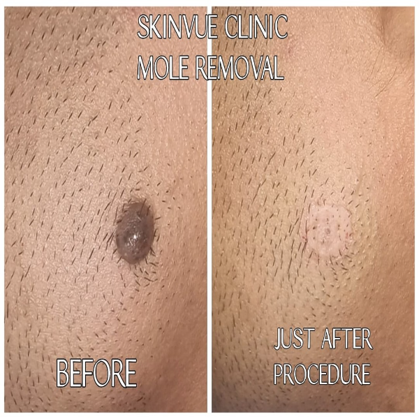 Mole Removal