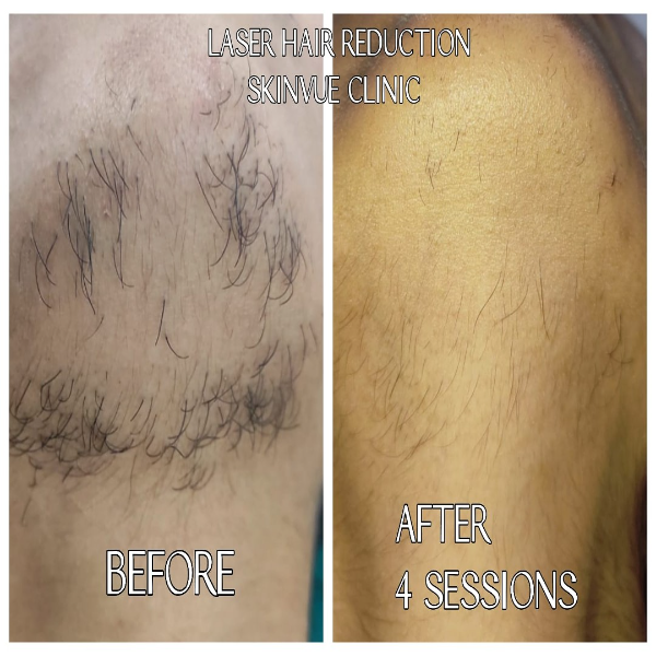 Laser Hair Reduction