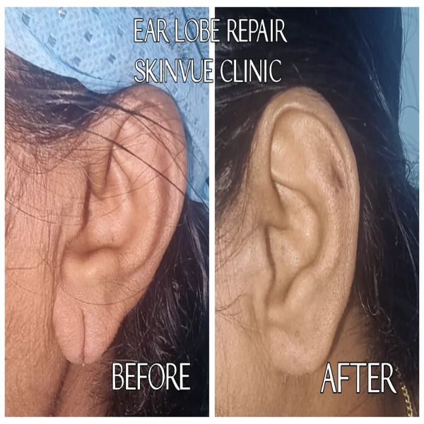 Earlobe Repair