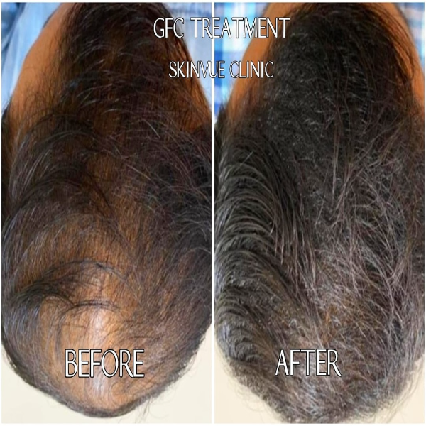 GFC TREATMENT