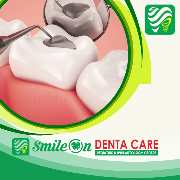 Fillings and sealants