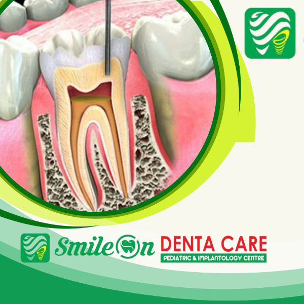 Root canal treatment