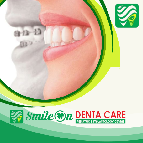 Orthodontic treatment- steel & ceramic braces,clear aligner