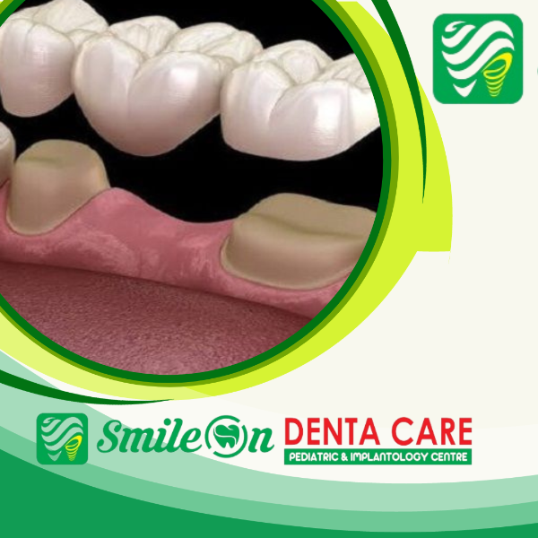 Bridges and Partial Dentures