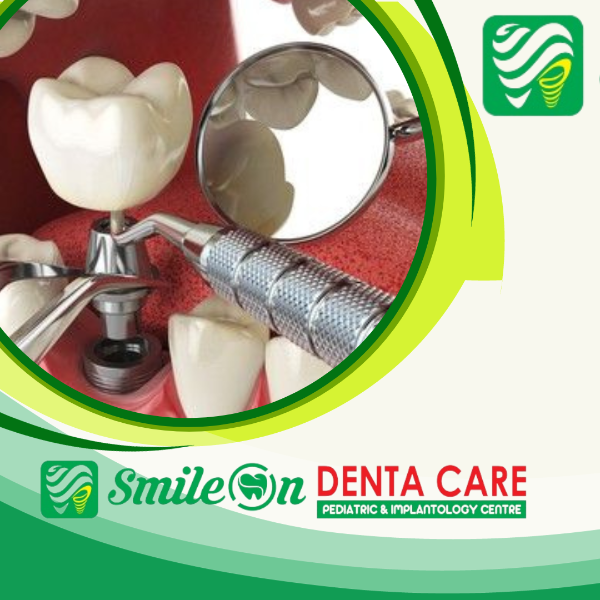 Dental implants