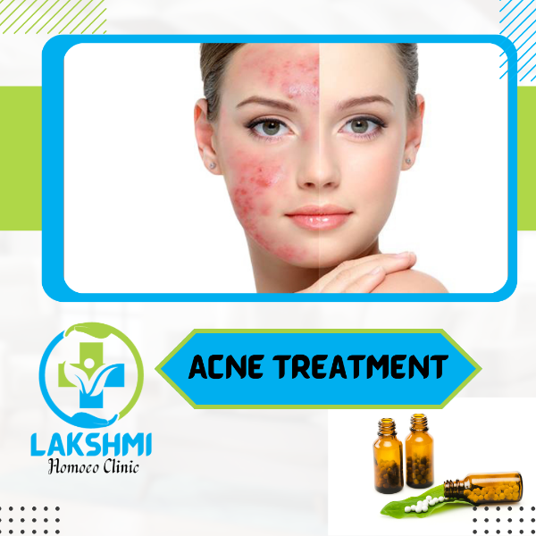 Acne Treatment