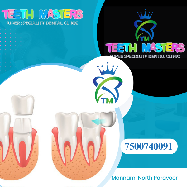 Veneers and Crown